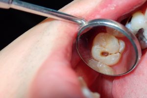 A dental tooth decay cavity found during routine dental examination check up using a dental mirror